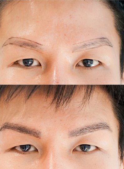 ผลลัพธ์ Eyebrow Transplant (EBT) ก่อนและหลัง 1