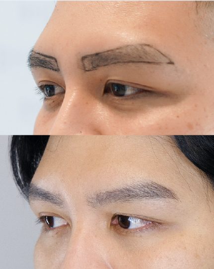 ผลลัพธ์ Eyebrow Transplant (EBT) ก่อนและหลัง 2