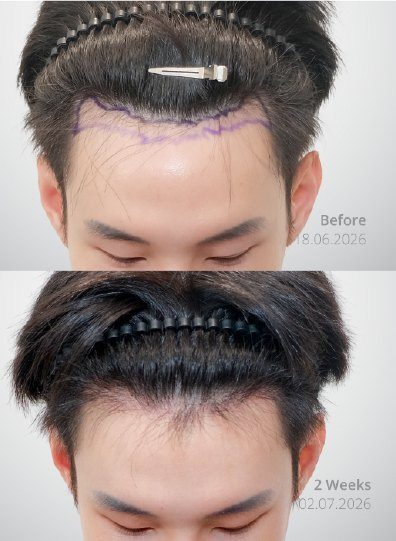 ภาพก่อนและหลังการรักษา ปลูกผม
