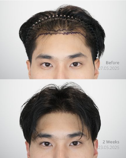 ผลลัพธ์ Long Hair DHI ก่อนและหลัง 2