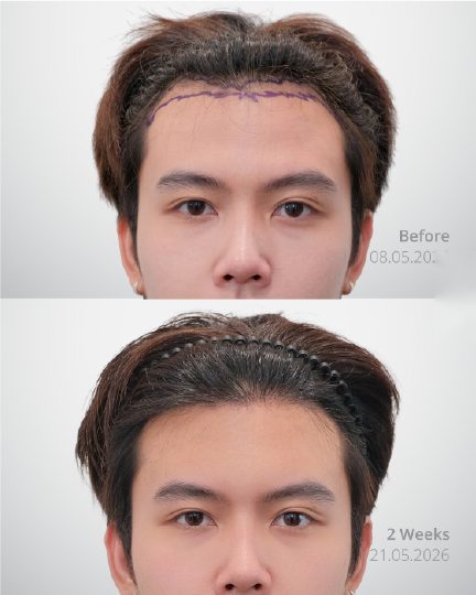 ผลลัพธ์ Long Hair DHI ก่อนและหลัง 3