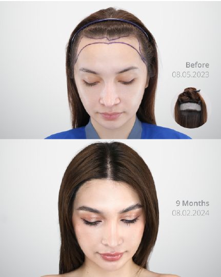 ผลลัพธ์ Partial Shave DHI ก่อนและหลัง 2