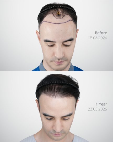 ผลลัพธ์ Shaven DHI Micrograft ก่อนและหลัง 2